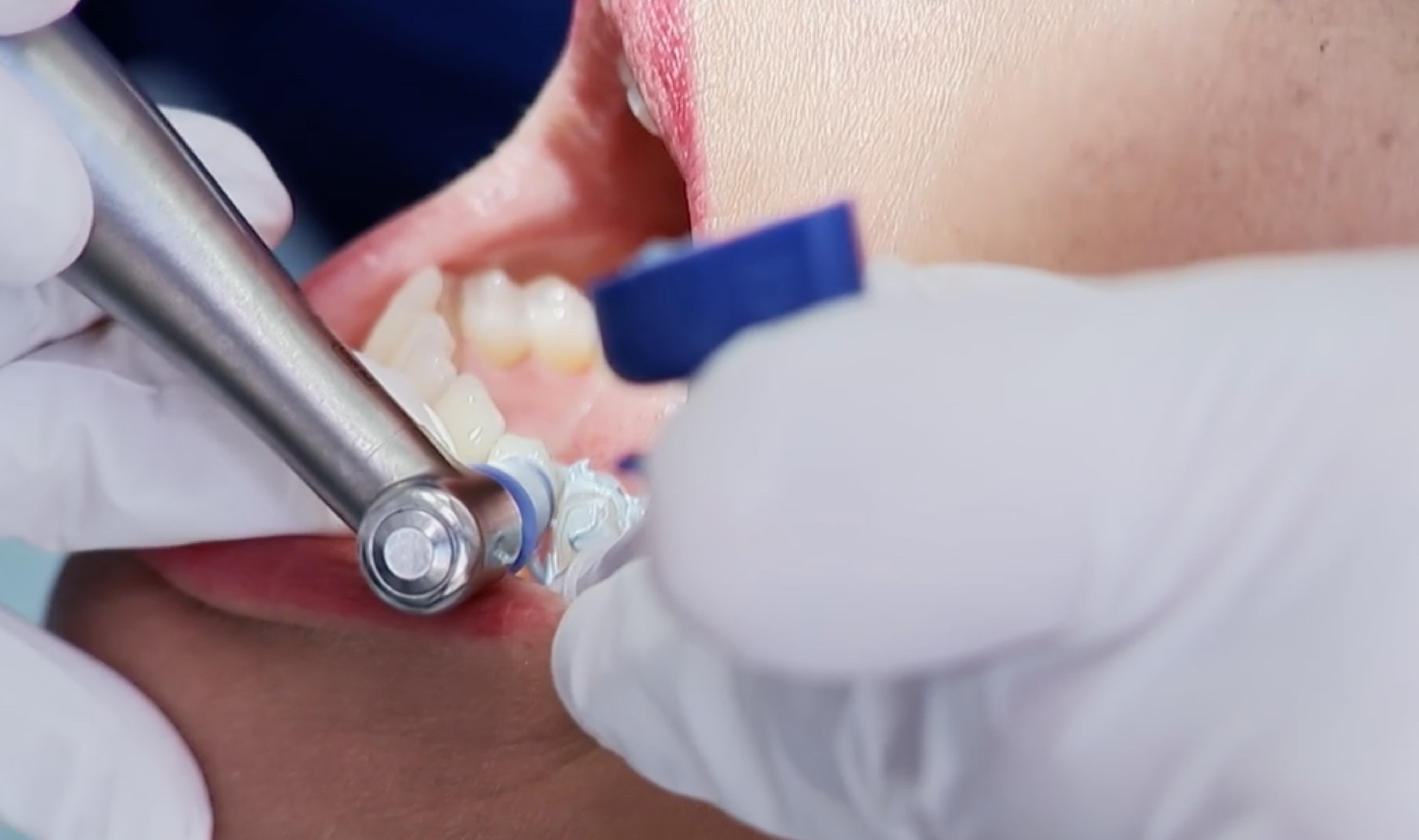 Professionelle Zahnreinigung Zahnarztpraxis Roger Barz Zahngesundheit Halle
